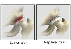 Hip Labral Repair