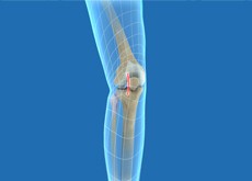 Minimally Invasive Knee Joint Replacement