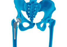 Outpatient Anterior Approach Hip Replacement