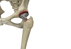 Periprosthetic Hip Infection