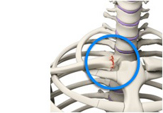 SC Joint Injury Reconstruction