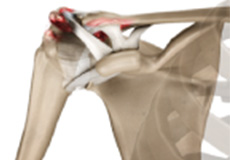 Acromioclavicular (AC) Arthritis