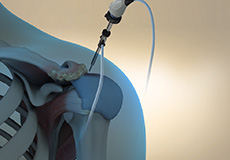 Arthroscopic Acromioplasty