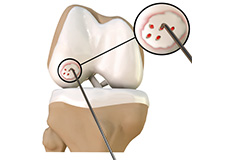 Cartilage microfracture