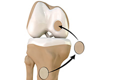 Chondroplasty