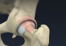 Femoroacetabular Osteoplasty