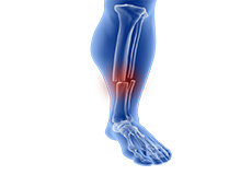 Tibia fractures