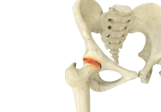 Inflammatory Arthritis of the Hip