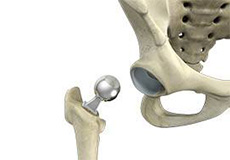 Hip Hemiarthroplasty