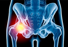 Hip Injury