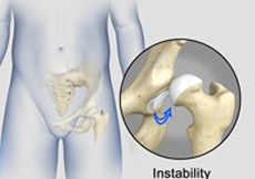 Hip Instability