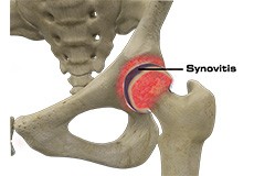 Hip Synovitis