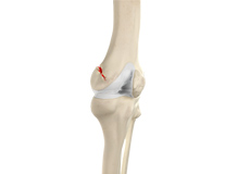 Knee Fracture