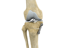 Knee Osteotomy