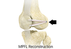 Medial Patellofemoral Ligament Reconstruction