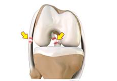 Multiligament Knee Injuries