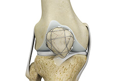 ORIF of the Knee Fracture