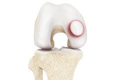 Osteochondral Allografts