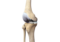 Partial Medial Knee Replacement