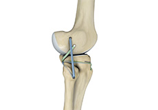 Posterolateral Corner Reconstruction