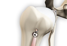 Proximal Biceps Tenodesis