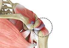 Rotator Cuff Pain