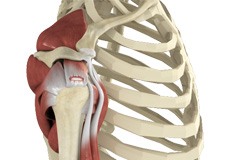 Rotator Cuff Tear