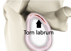Shoulder Labral Tear