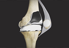 Tricompartmental Knee Replacement