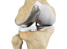 Unicompartmental/Partial Knee Replacement